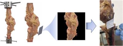 Precision soft tissue balancing: grid-assisted pie-crusting in total knee arthroplasty